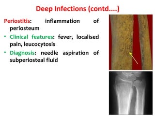Deep Infections (contd....)
Periostitis: inflammation of
periosteum
• Clinical features: fever, localised
pain, leucocytosis
• Diagnosis: needle aspiration of
subperiosteal fluid
 
