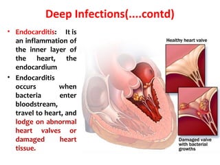 Deep Infections(....contd)
• Endocarditis: It is
an inflammation of
the inner layer of
the heart, the
endocardium
• Endocarditis
occurs when
bacteria enter
bloodstream,
travel to heart, and
lodge on abnormal
heart valves or
damaged heart
tissue.
 