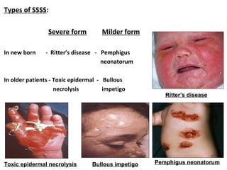 Types of SSSS:
Severe form Milder form
In new born - Ritter’s disease - Pemphigus
neonatorum
In older patients - Toxic epidermal - Bullous
necrolysis impetigo
Toxic epidermal necrolysis
Ritter’s disease
Bullous impetigo Pemphigus neonatorum
 