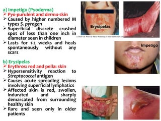 a) Impetigo (Pyoderma)
 Pyo-purulent and derma-skin
 Caused by higher numbered M
types S. pyrogen
 Superficial discrete crushed
spot of less than one inch in
diameter seen in children
 Lasts for 1-2 weeks and heals
spontaneously without any
scars
b) Erysipelas
 Erythros: red and pella: skin
 Hypersensitivity reaction to
Streptococcal antigen
 Causes acute spreading lesions
involving superficial lymphatics
 Affected skin is red, swollen,
indurated and sharply
demarcated from surrounding
healthy skin
 Rare and seen only in older
patients
Erysipelas
Impetigo
 