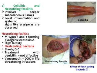 c) Cellulitis and
Necrotising fascilitis
Involves deeper
subcutaneous tissues
Local inflammation and
systemic
signs like erysipelas are
observed
Necrotising faciitis :
• M types 1 and 3 forming
pyrogenic exotoxin A
• High fatality
• Flesh eating bacteria
• Shock, DIC
• Treatment with
penicillin – not effective
• Vancomycin – DOC in life
threatening infections
Effect of flesh eating
bacteria 
Cellulitis
Necrotising fascitis
 