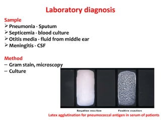 Laboratory diagnosis
Sample
Pneumonia - Sputum
Septicemia - blood culture
Otitis media - fluid from middle ear
Meningitis - CSF
Method
– Gram stain, microscopy
– Culture
Latex agglutination for pneumococcal antigen in serum of patients
 