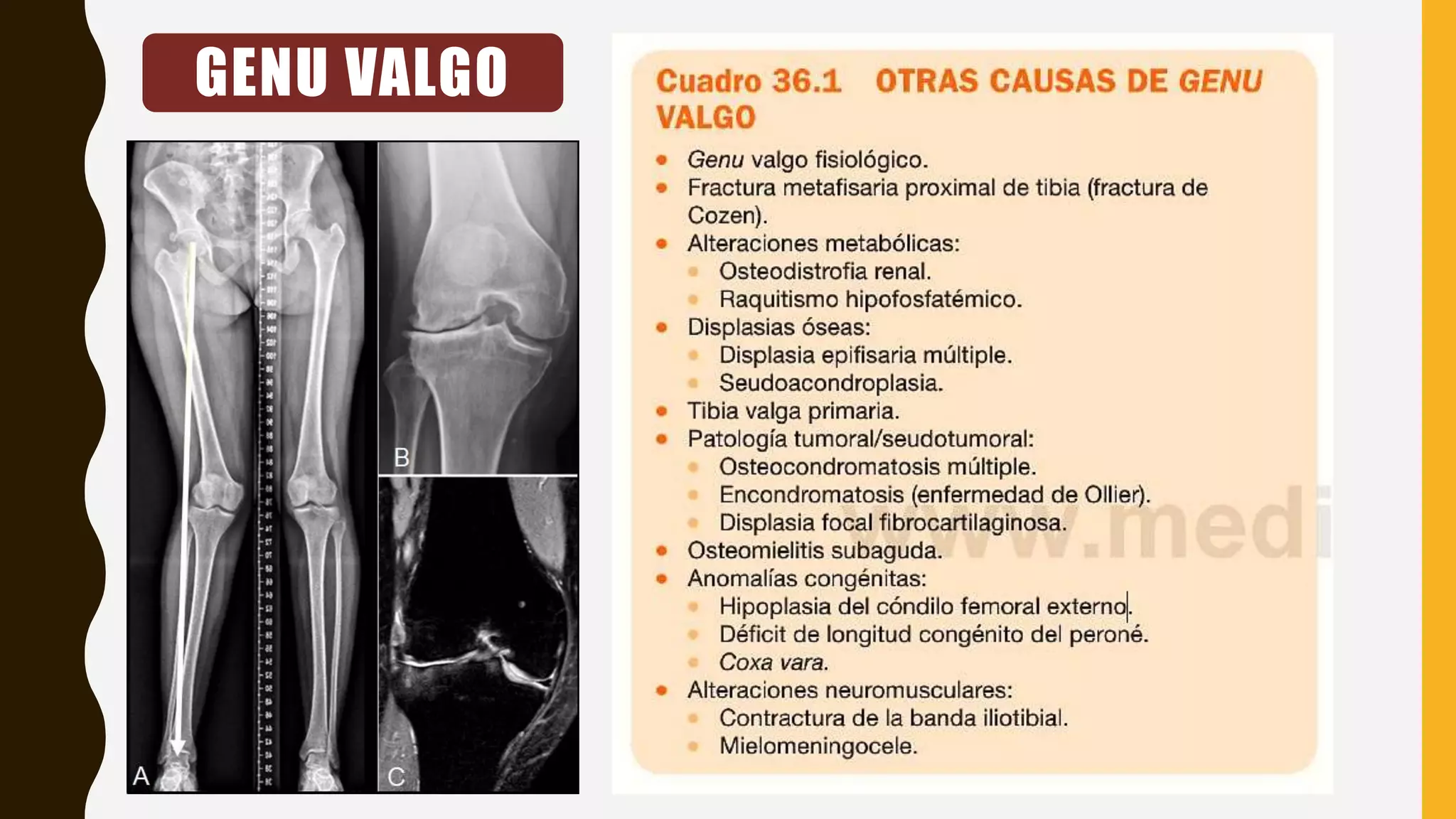Genu valgo | PPTX