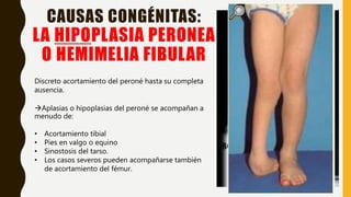 CAUSAS CONGÉNITAS:
LA HIPOPLASIA PERONEA
O HEMIMELIA FIBULAR
Discreto acortamiento del peroné hasta su completa
ausencia.
Aplasias o hipoplasias del peroné se acompañan a
menudo de:
• Acortamiento tibial
• Pies en valgo o equino
• Sinostosis del tarso.
• Los casos severos pueden acompañarse también
de acortamiento del fémur.
 