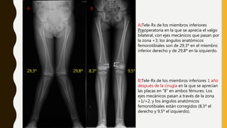 A)Tele-Rx de los miembros inferiores
Preoperatoria en la que se aprecia el valgo
bilateral, con ejes mecánicos que pasan por
la zona +3; los ángulos anatómicos
femorotibiales son de 29,3º en el miembro
inferior derecho y de 29,8º en la izquierdo.
A B
B)Tele-Rx de los miembros inferiores 1 año
después de la cirugía en la que se aprecian
las placas en “8” en ambos fémures. Los
ejes mecánicos pasan a través de la zona
+1/+2, y los ángulos anatómicos
femorotibiales están corregidos (8,3º el
derecho y 9,5º el izquierdo).
29,3º 29,8º 8,3º 9,5º
 
