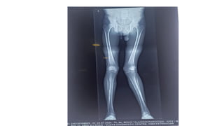 GENU VALGUM knee deformity clinical case | PPTX