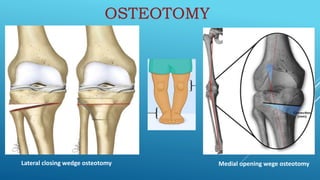 Lateral closing wedge osteotomy Medial opening wege osteotomy
OSTEOTOMY
 