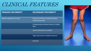 CLINICAL FEATURES
PRIMARY DEFORMITY SECONDARY DEFORMITY
Medial angulation of knee Distal end of femur & proximal tibia
rotated externally
Compensatory internal torsion of distal
tibia
Lateral dislocation of patella
Tight lateral & lax medial structures
Flat foot
 