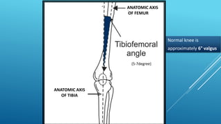 ANATOMIC AXIS
OF FEMUR
ANATOMIC AXIS
OF TIBIA
(5-7degree)
Normal knee is
approximately 6° valgus
 