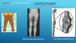 Severe ( > 10 cm IM at 10 years )
OSTEOTOMY
Medial Closing wedge osteotomy Lateral Opening wedge Osteotomy
 