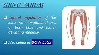 GENU VALGUM VARUM pptx