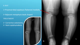 X RAY
Proximal tibial epiphysis flattened medially
Adjacent metaphysis beak shaped
TREATMENT
 Corrective osteotomy
 Hemi epiphysiodesis
 