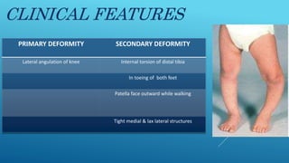 CLINICAL FEATURES
PRIMARY DEFORMITY SECONDARY DEFORMITY
Lateral angulation of knee Internal torsion of distal tibia
In toeing of both feet
Patella face outward while walking
Tight medial & lax lateral structures
 