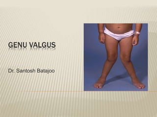 GENU VALGUS
Dr. Santosh Batajoo
 