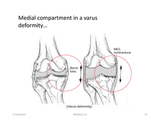 27/04/2015 11
Medial compartment in a varus
deformity…
AYODELE A.E
 
