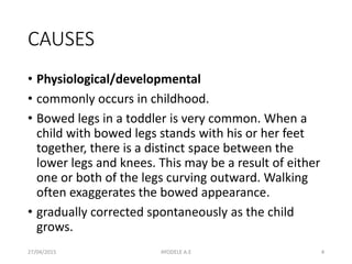 CAUSES
• Physiological/developmental
• commonly occurs in childhood.
• Bowed legs in a toddler is very common. When a
child with bowed legs stands with his or her feet
together, there is a distinct space between the
lower legs and knees. This may be a result of either
one or both of the legs curving outward. Walking
often exaggerates the bowed appearance.
• gradually corrected spontaneously as the child
grows.
27/04/2015 4AYODELE A.E
 