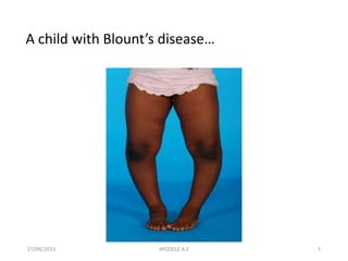27/04/2015 7
A child with Blount’s disease…
AYODELE A.E
 