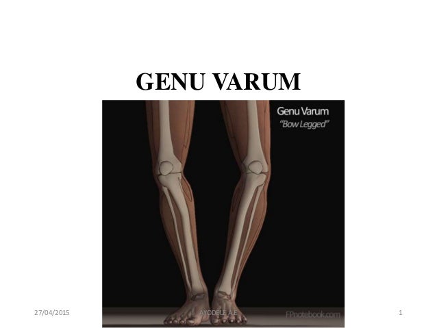 Genu Varum Genu Varum