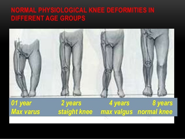 Genu varum valgus coxa varum Genu varum valgus coxa varum