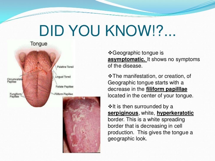 Geographic Tongue: Causes and Treatments - WebMD