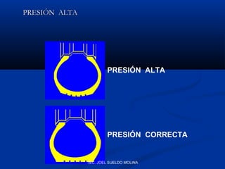 PRESIÓN ALTA

PRESIÓN ALTA

PRESIÓN CORRECTA

TEC. JOEL SUELDO MOLINA

 