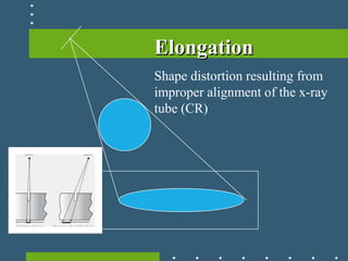 ElongationElongation
Shape distortion resulting from
improper alignment of the x-ray
tube (CR)
 