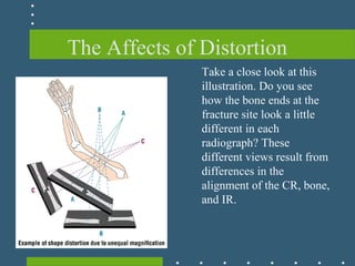 The Affects of Distortion
Take a close look at this
illustration. Do you see
how the bone ends at the
fracture site look a little
different in each
radiograph? These
different views result from
differences in the
alignment of the CR, bone,
and IR.
 