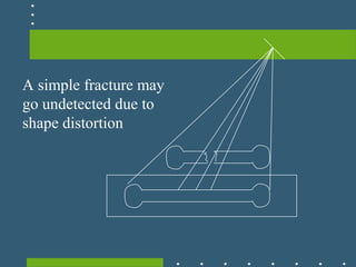 A simple fracture may
go undetected due to
shape distortion
 