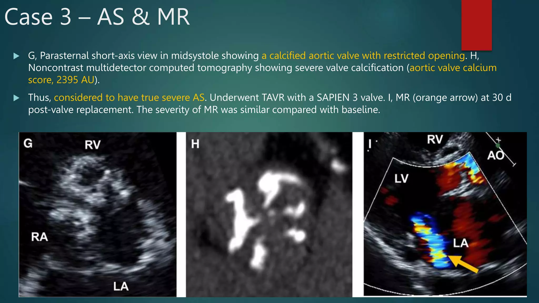 Evaluation of Mixed Valvular Heart Disease on Echo | PPTX