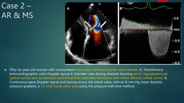 Evaluation of Mixed Valvular Heart Disease on Echo | PPTX | Heart and ...