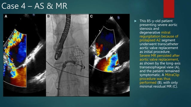 Evaluation of Mixed Valvular Heart Disease on Echo | PPTX | Heart and ...
