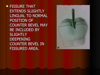 FISSURE THAT EXTENDS SLIGHTLY LINGUAL TO NORMAL POSITION OF COUNTER BEVEL MAY BE INCLUDED BY SLIGHTLY DEEPENING COUNTER BEVEL IN FISSURED AREA. 