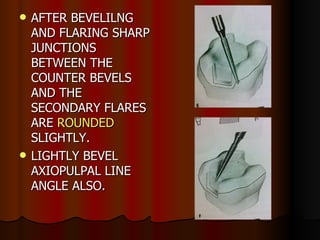 AFTER BEVELILNG AND FLARING SHARP JUNCTIONS BETWEEN THE COUNTER BEVELS AND THE SECONDARY FLARES ARE  ROUNDED  SLIGHTLY.  LIGHTLY BEVEL AXIOPULPAL LINE ANGLE ALSO. 