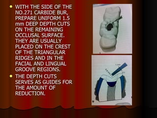 WITH THE SIDE OF THE NO.271 CARBIDE BUR, PREPARE UNIFORM 1.5 mm DEEP DEPTH CUTS ON THE REMAINING OCCLUSAL SURFACE. THEY ARE USUALLY PLACED ON THE CREST OF THE TRIANGULAR RIDGES AND IN THE FACIAL AND LINGUAL GROOVE REGIONS. THE DEPTH CUTS SERVES AS GUIDES FOR THE AMOUNT OF REDUCTION. 