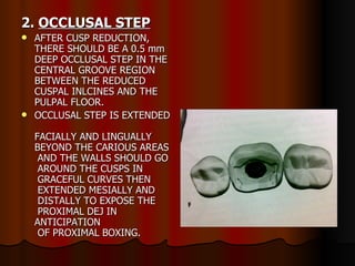 2.  OCCLUSAL STEP AFTER CUSP REDUCTION, THERE SHOULD BE A 0.5 mm DEEP OCCLUSAL STEP IN THE CENTRAL GROOVE REGION BETWEEN THE REDUCED CUSPAL INLCINES AND THE PULPAL FLOOR. OCCLUSAL STEP IS EXTENDED  FACIALLY AND LINGUALLY  BEYOND THE CARIOUS AREAS  AND THE WALLS SHOULD GO  AROUND THE CUSPS IN  GRACEFUL CURVES THEN  EXTENDED MESIALLY AND  DISTALLY TO EXPOSE THE  PROXIMAL DEJ IN ANTICIPATION  OF PROXIMAL BOXING. 