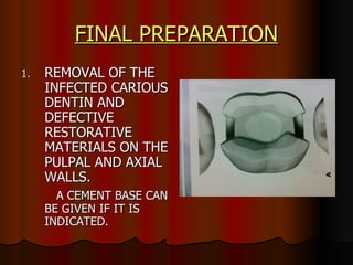 FINAL PREPARATION REMOVAL OF THE INFECTED CARIOUS DENTIN AND DEFECTIVE RESTORATIVE MATERIALS ON THE PULPAL AND AXIAL WALLS.  A CEMENT BASE CAN BE GIVEN IF IT IS INDICATED. 