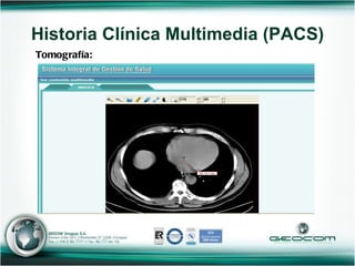 Tomografía: Historia Clínica Multimedia (PACS) 