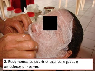 2. Recomenda-se cobrir o local com gazes e
umedecer o mesmo.
 