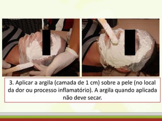 3. Aplicar a argila (camada de 1 cm) sobre a pele (no local
da dor ou processo inflamatório). A argila quando aplicada
não deve secar.
 