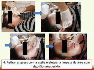 4. Retirar as gazes com a argila e efetuar a limpeza da área com
algodão umedecido.
 