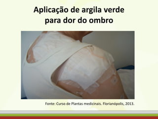 Aplicação de argila verde
para dor do ombro
Fonte: Curso de Plantas medicinais. Florianópolis, 2013.
 