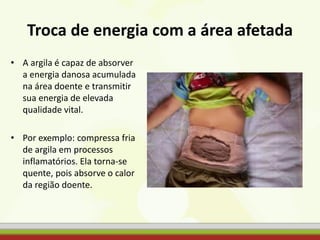 Troca de energia com a área afetada
• A argila é capaz de absorver
a energia danosa acumulada
na área doente e transmitir
sua energia de elevada
qualidade vital.
• Por exemplo: compressa fria
de argila em processos
inflamatórios. Ela torna-se
quente, pois absorve o calor
da região doente.
 