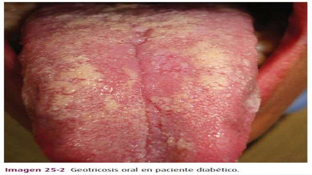 Geotricosis (micosis oportunista)