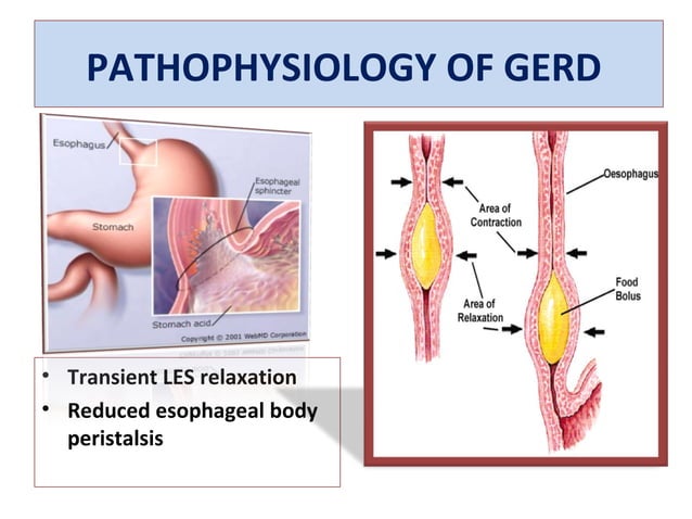 Gerd Path GERD IN CHILDREN | PPT