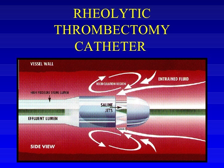 Gerber Pulmonary Embolism