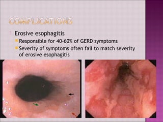  Erosive esophagitis
 Responsible for 40-60% of GERD symptoms
 Severity of symptoms often fail to match severity
of erosive esophagitis
 