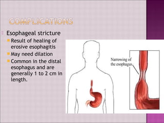  Esophageal stricture
 Result of healing of
erosive esophagitis
 May need dilation
 Common in the distal
esophagus and are
generally 1 to 2 cm in
length.
 