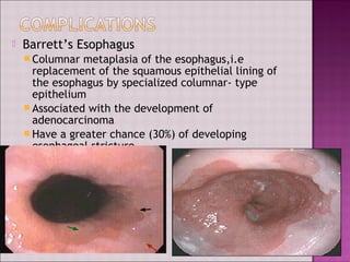  Barrett’s Esophagus
 Columnar metaplasia of the esophagus,i.e
replacement of the squamous epithelial lining of
the esophagus by specialized columnar- type
epithelium
 Associated with the development of
adenocarcinoma
 Have a greater chance (30%) of developing
esophageal stricture
 