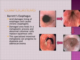  Barrett’s Esophagus
 Acid damages lining of
esophagus and causes
chronic esophagitis
 Damaged area heals in a
metaplastic process and
abnormal columnar cells
replace squamous cells
 This specialized intestinal
metaplasia can progress to
dysplasia and
adenocarcinoma
 