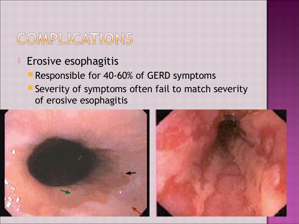 GASTROESOPHAGEAL REFLUX DISEASE gastroesophageal-reflux-disease